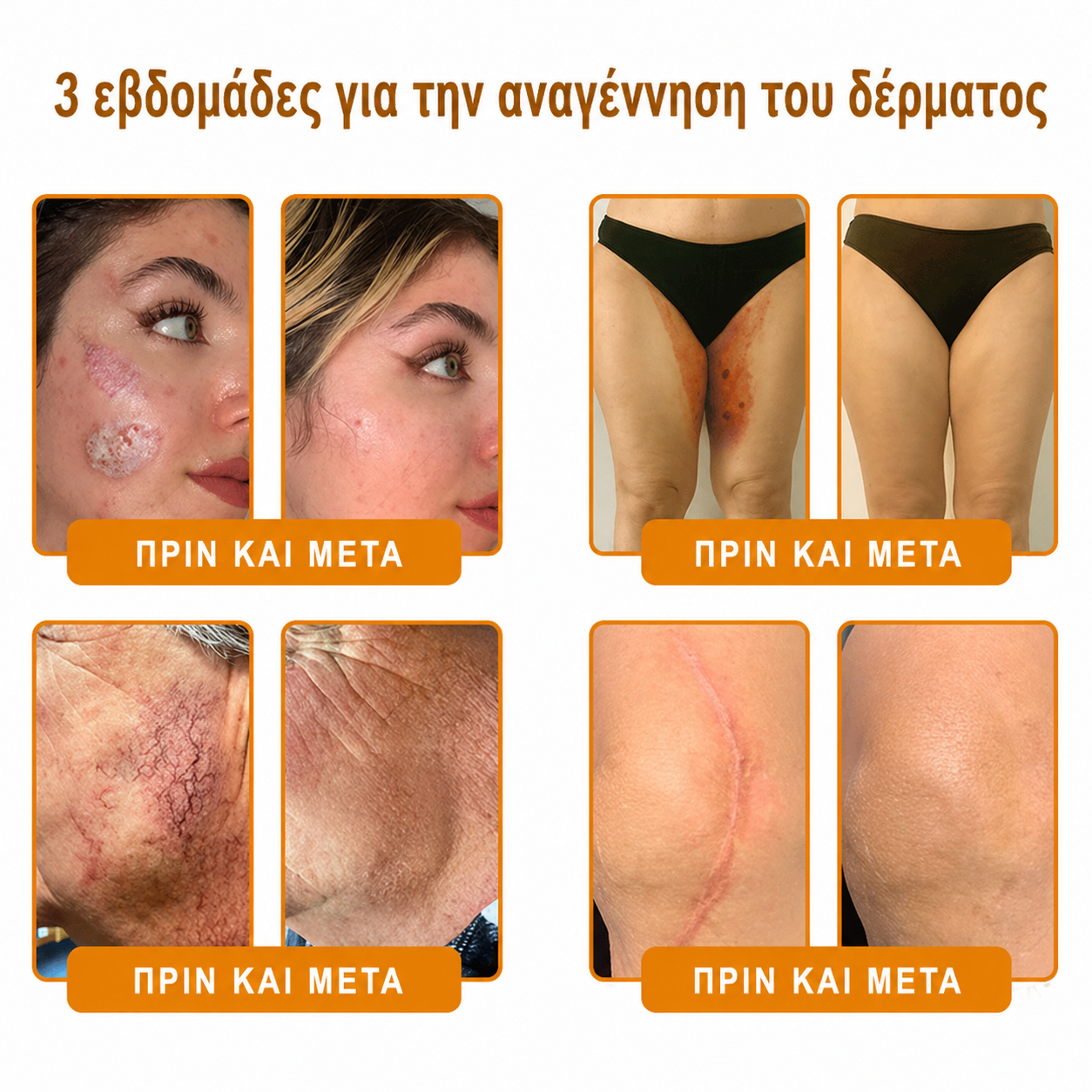 👩‍⚕️Συνιστάται από το Νοσοκομείο Semmelweis · Επίσημο κατάστημα BENU✨ Hudros® Κρέμα Ανανέωσης Δέρματος με Δηλητήριο Μέλισσας