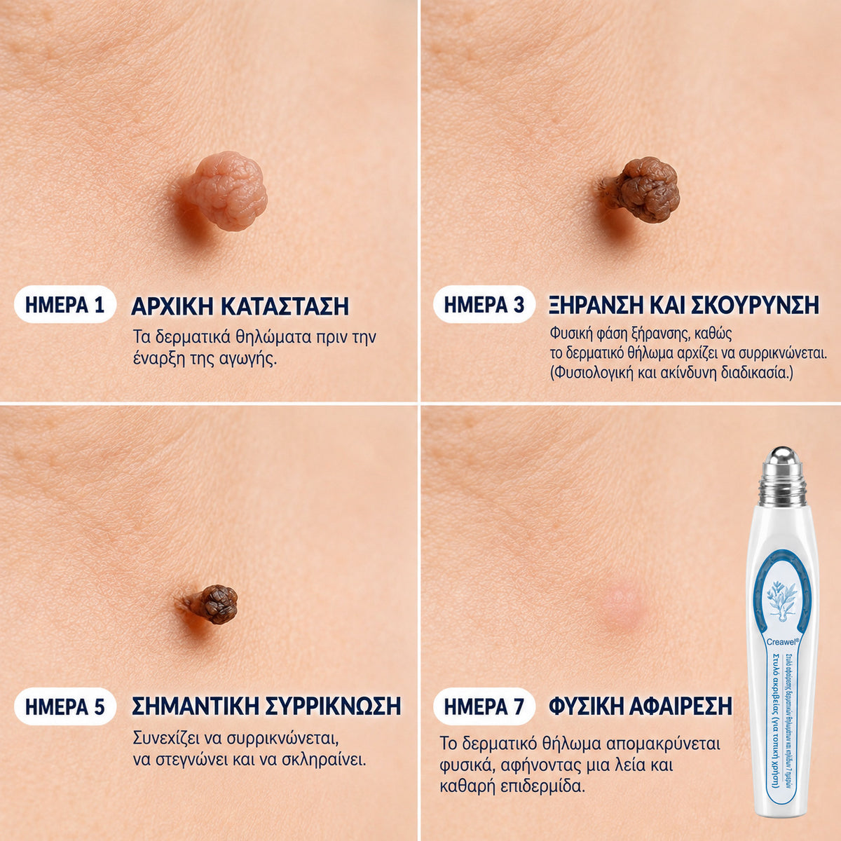🥥 Επίσημο κατάστημα Creawel® Διορθωτικό Roll-On 7 Ημερών για Θηλώματα & Κηλίδες (ανώδυνο, χωρίς σημάδια)🖋️🌕2️⃣7️⃣