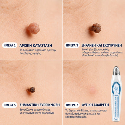 🥥 Επίσημο κατάστημα Creawel® Διορθωτικό Roll-On 7 Ημερών για Θηλώματα & Κηλίδες (ανώδυνο, χωρίς σημάδια)🖋️🌕2️⃣7️⃣