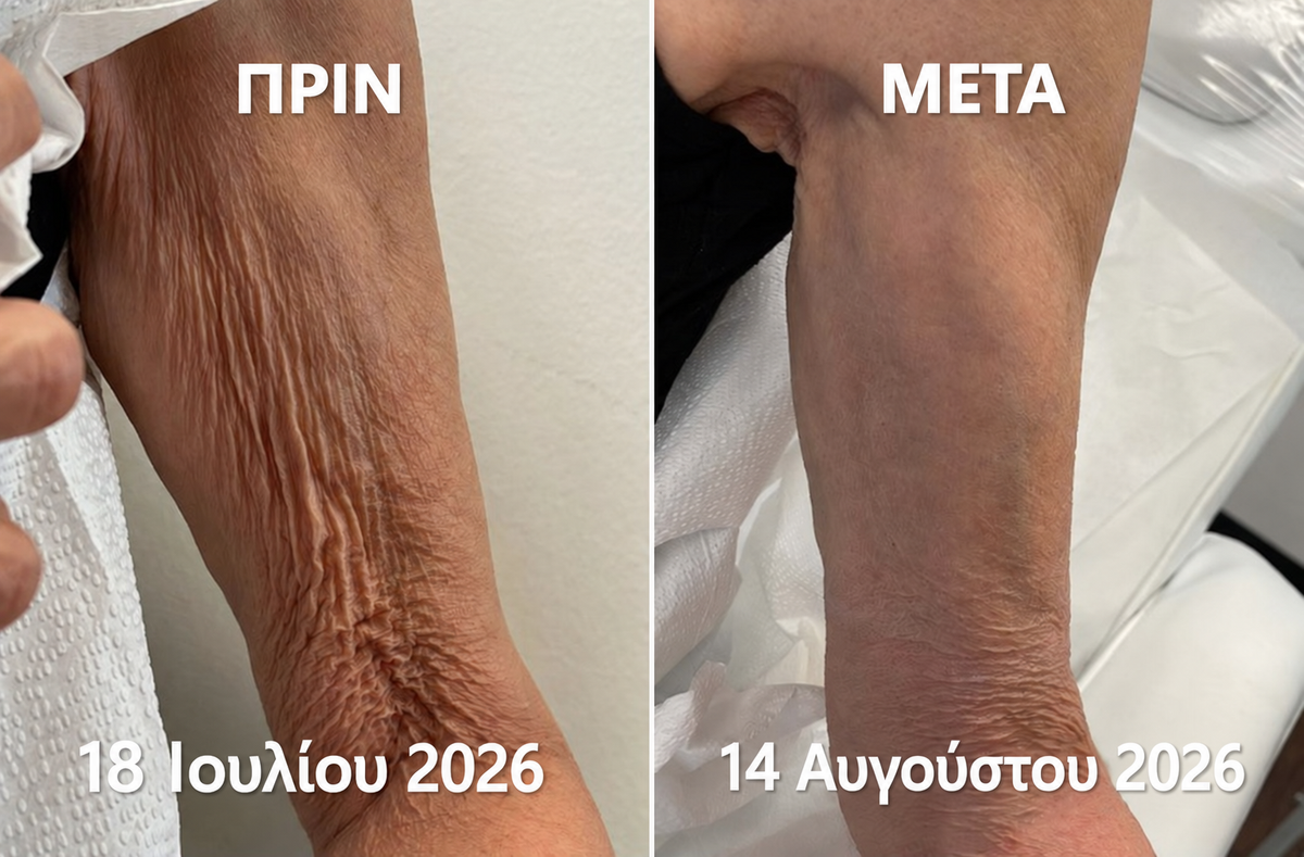 Healrize PDRN — Πριν και μετά στο χέρι