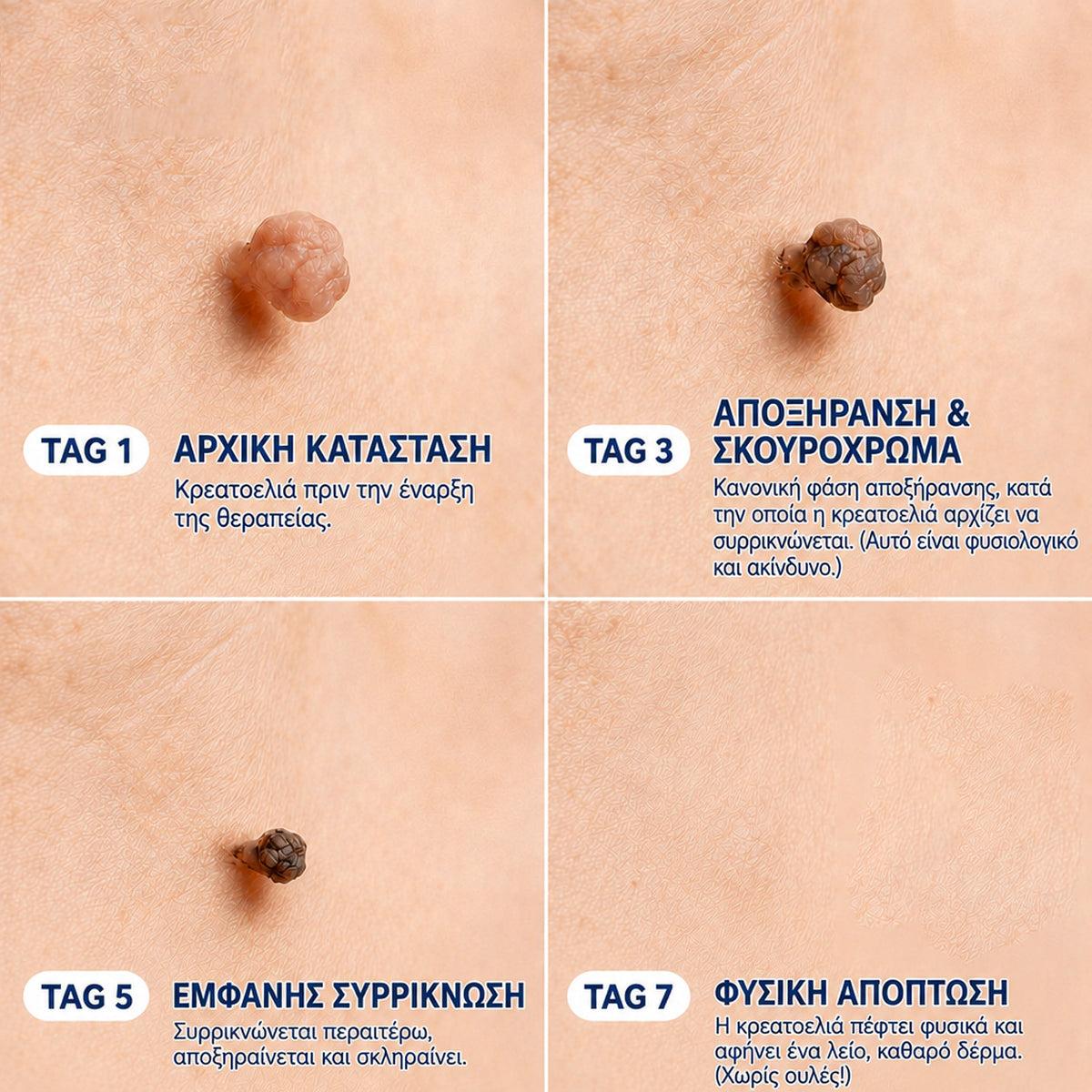 🧩 CureVivo® Κρέμα 7 Ημερών για Θηλώματα & Κηλίδες (ανώδυνη σύνθεση – χωρίς ουλές)🤗