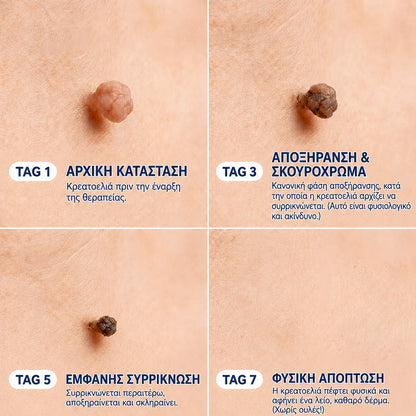 🧩 CureVivo® Κρέμα 7 Ημερών για Θηλώματα & Κηλίδες (ανώδυνη σύνθεση – χωρίς ουλές)🤗