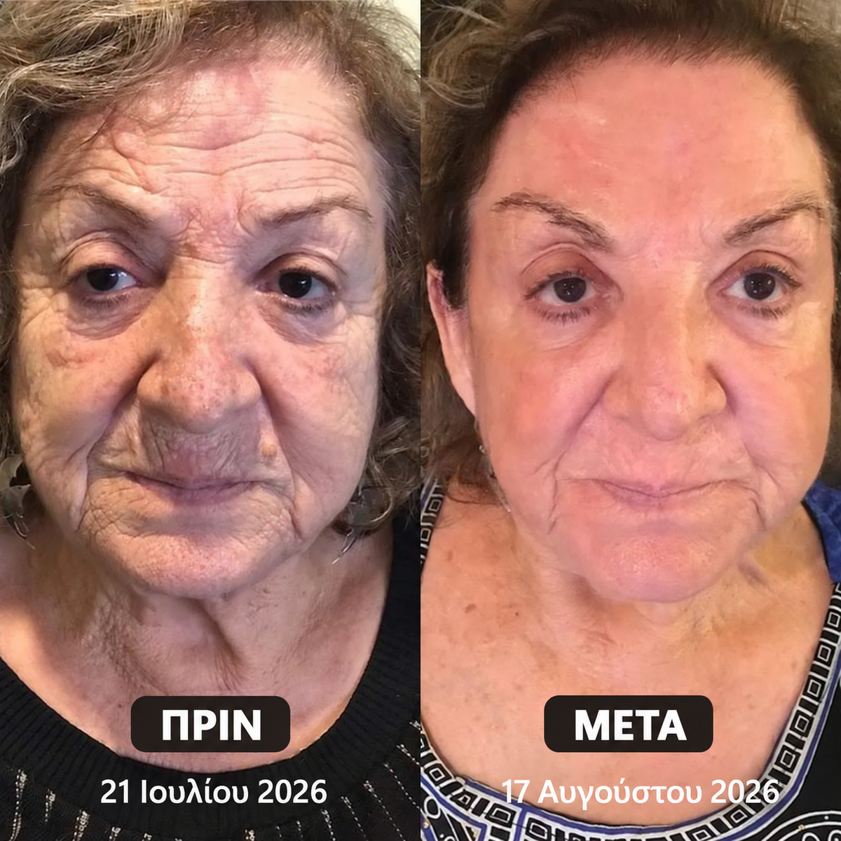 Healrize PDRN — Πριν και μετά στο πρόσωπο