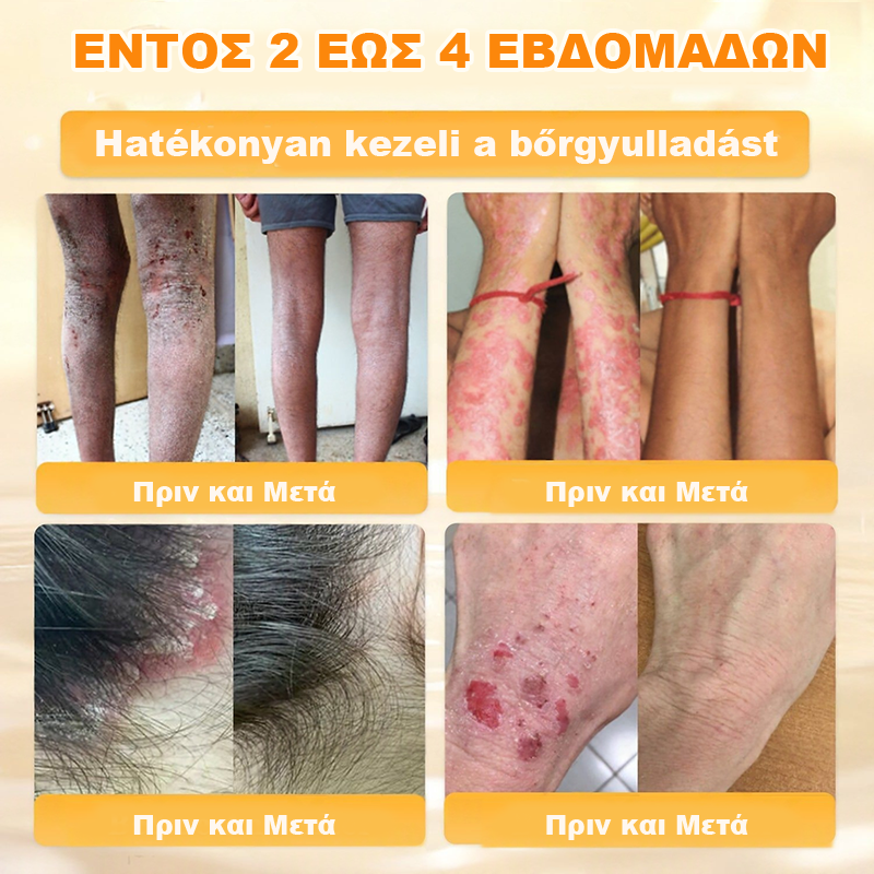 👩‍⚕️Συνιστάται από το Νοσοκομείο Semmelweis · Επίσημο κατάστημα BENU✨ Hudros® Κρέμα Ανανέωσης Δέρματος με Δηλητήριο Μέλισσας