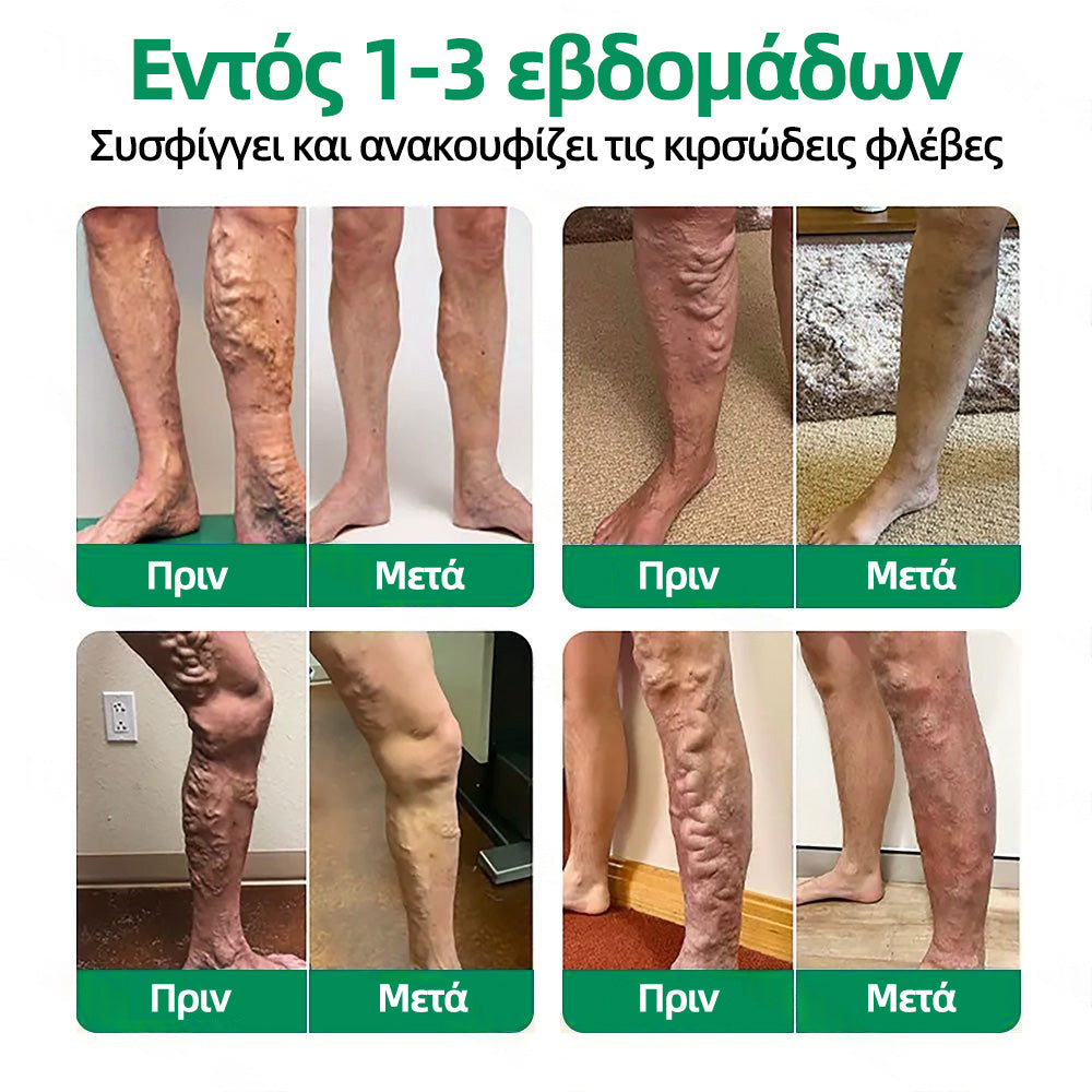 🇬🇷👨‍⚕️✅ Healrize® VeinTarget Μικροβελονιστικό Επίθεμα⚡Άμεση Ανακούφιση, Μακροχρόνια Αποτελέσματα🥝