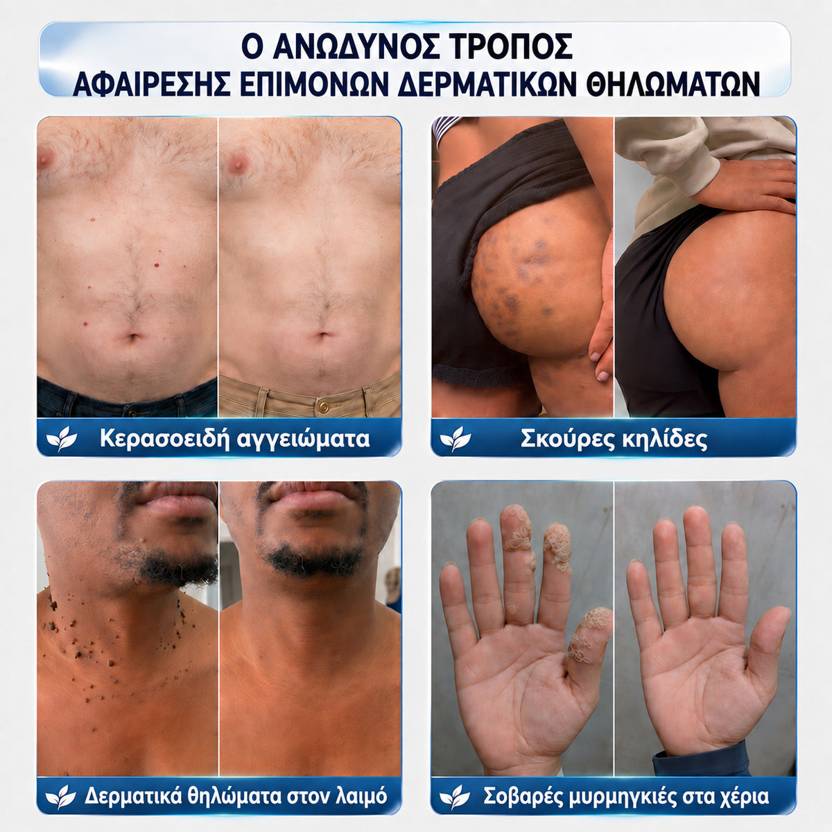 🧩 CureVivo® Κρέμα 7 Ημερών για Θηλώματα & Κηλίδες (ανώδυνη σύνθεση – χωρίς ουλές)🤗