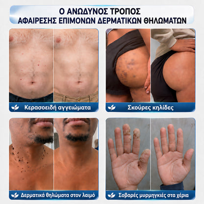 🧩 CureVivo® Κρέμα 7 Ημερών για Θηλώματα & Κηλίδες (ανώδυνη σύνθεση – χωρίς ουλές)🤗