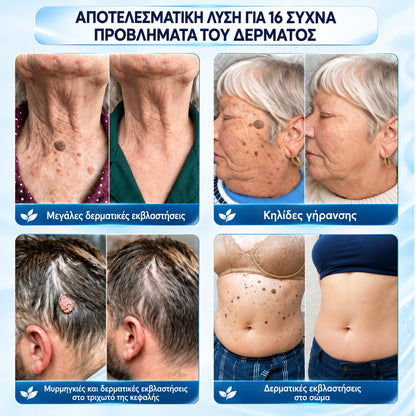 🧩 CureVivo® Κρέμα 7 Ημερών για Θηλώματα & Κηλίδες (ανώδυνη σύνθεση – χωρίς ουλές)🤗