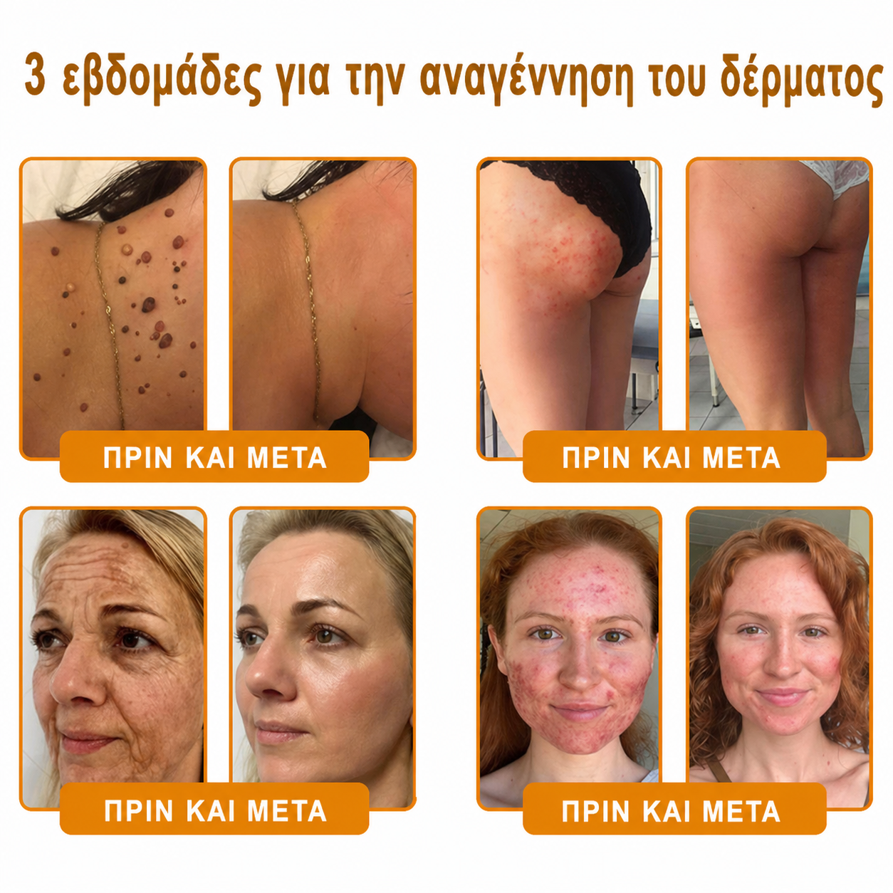 👩‍⚕️Συνιστάται από το Νοσοκομείο Semmelweis · Επίσημο κατάστημα BENU✨ Hudros® Κρέμα Ανανέωσης Δέρματος με Δηλητήριο Μέλισσας